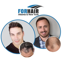 Finding Your Ideal Micro Scalp Pigmentation Clinic