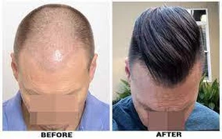 Finding Your Ideal Micro Scalp Pigmentation Clinic - 2