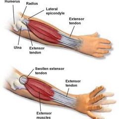 Tennis Elbow Treatment in Surrey
